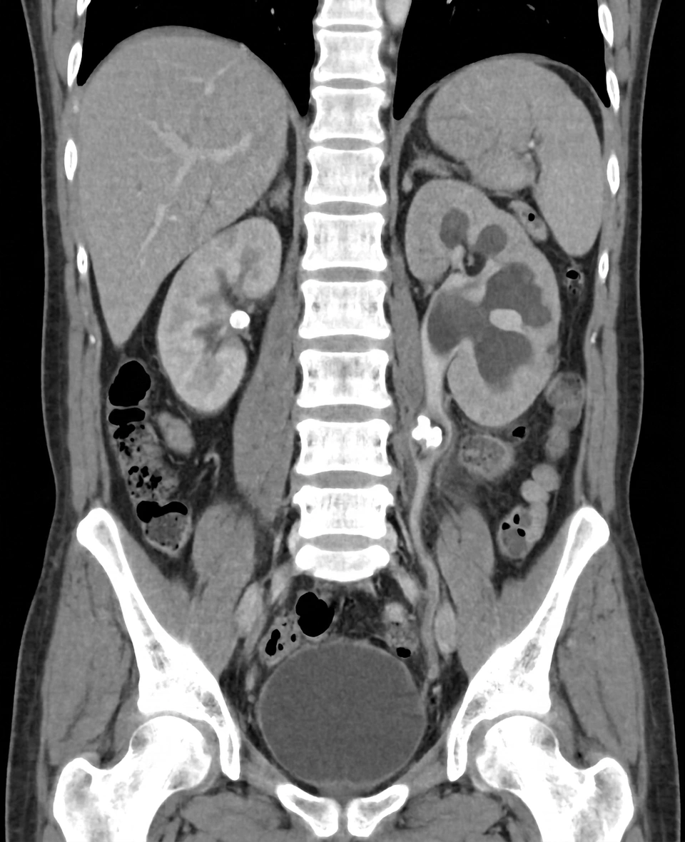 Cálculo ureteral con hidronefrosis en TC sin contraste