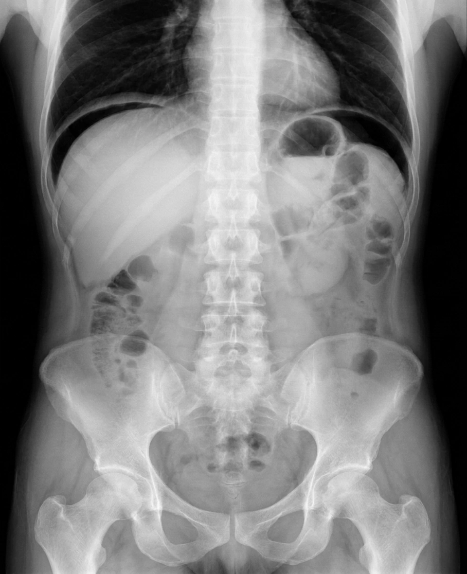 Neumoperitoneo en radiografía de abdomen