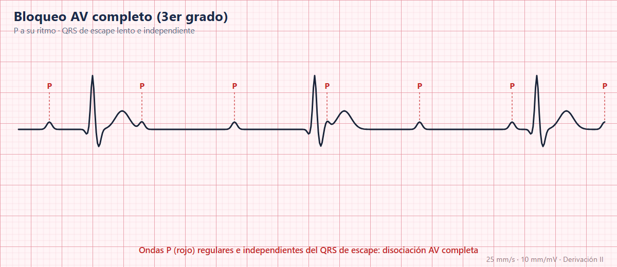 Bloqueo AV completo en el ECG