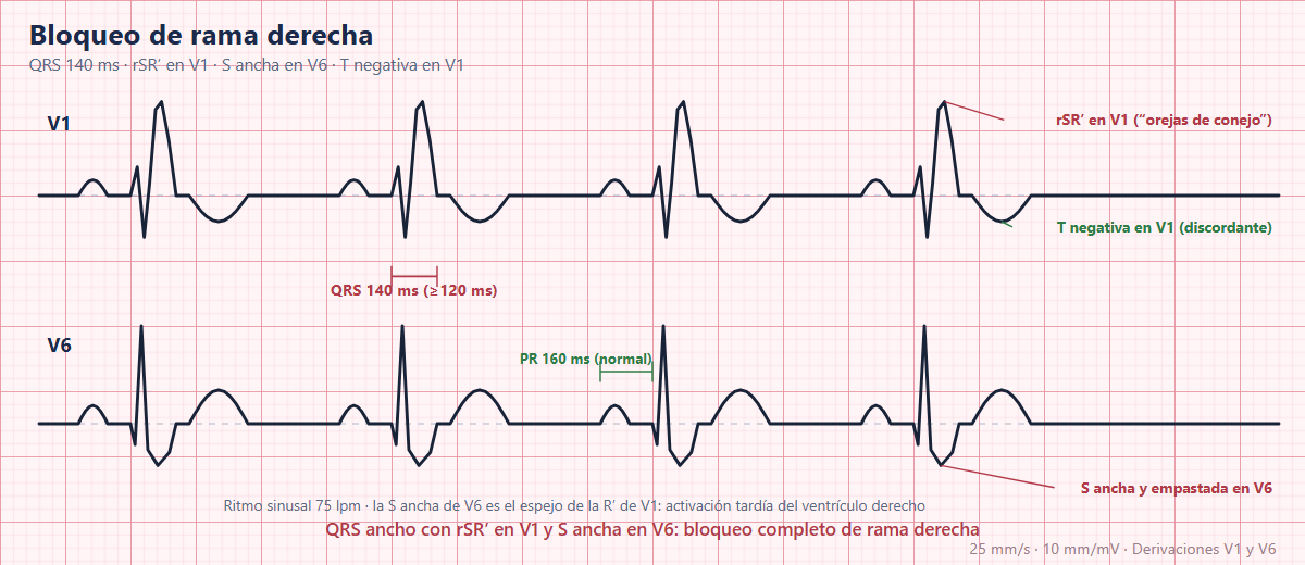 Bloqueo de rama derecha en el ECG