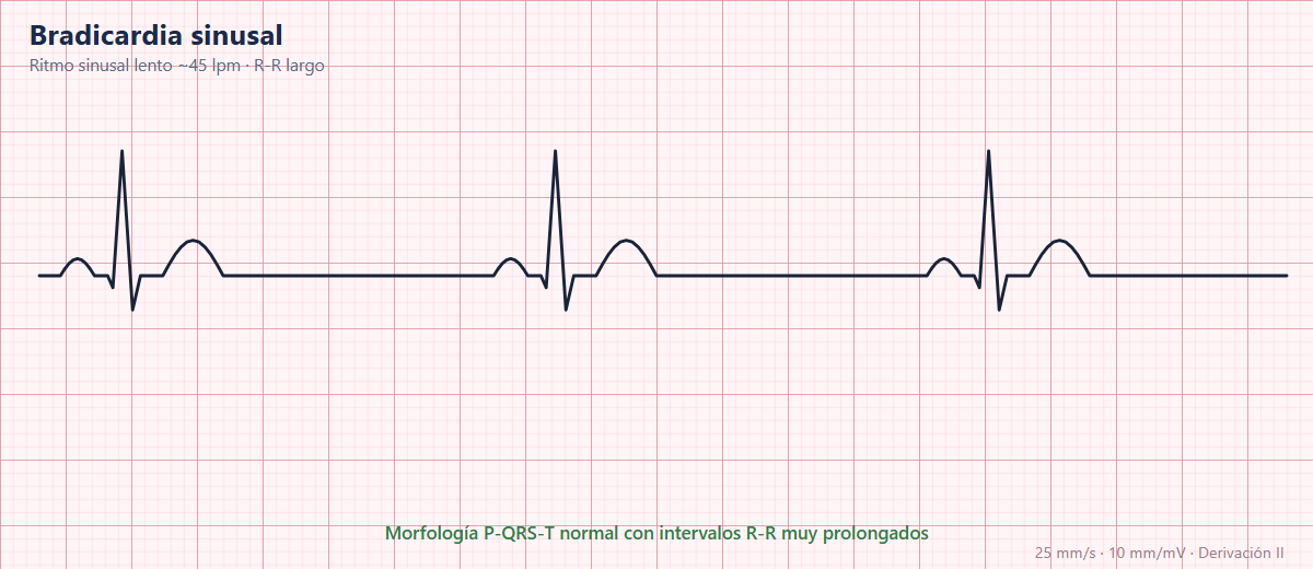 Bradicardia sinusal en el ECG