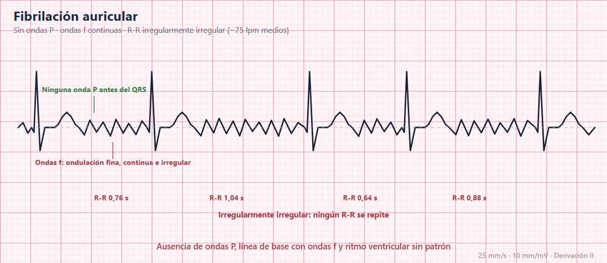 Fibrilación auricular en el ECG