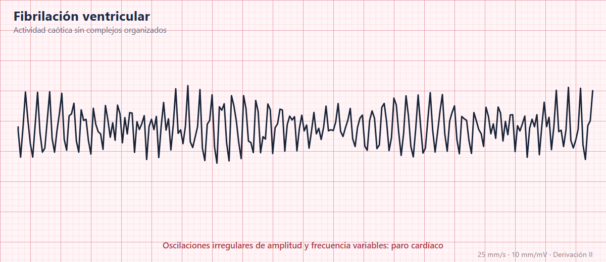 Fibrilación ventricular en el ECG