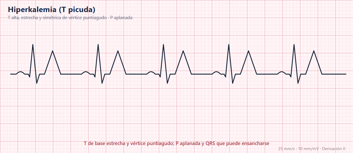 Ondas T picudas por hiperpotasemia en el ECG