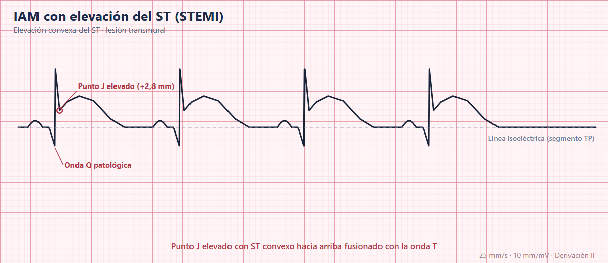 Infarto con elevación del ST en el ECG
