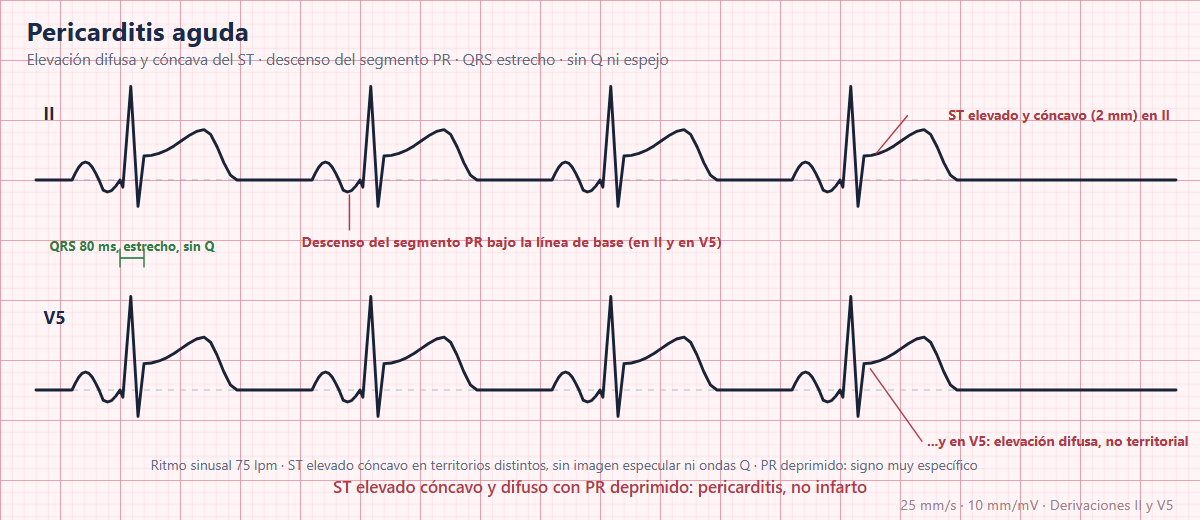 Pericarditis aguda en el ECG