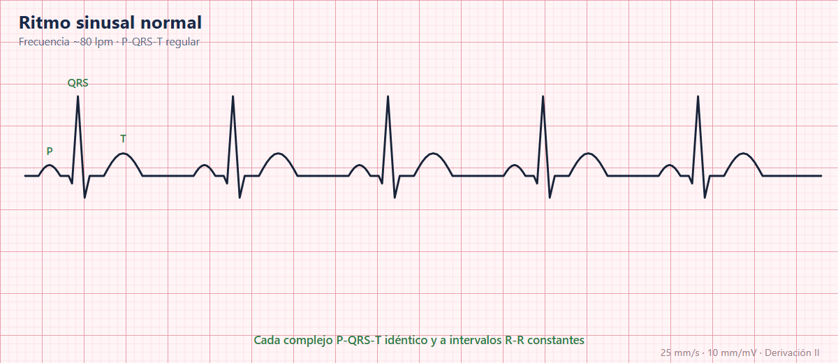 ECG normal: ritmo sinusal, ondas e intervalos de referencia