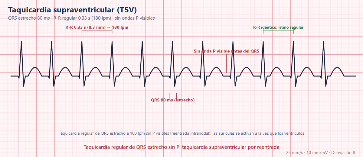Taquicardia supraventricular en el ECG