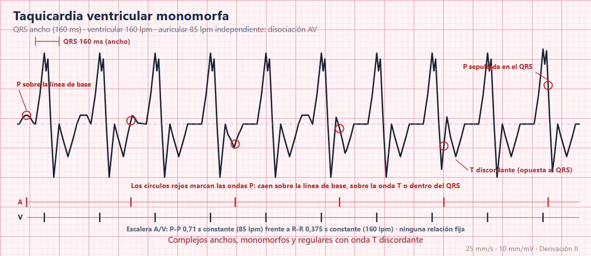 Taquicardia ventricular en el ECG