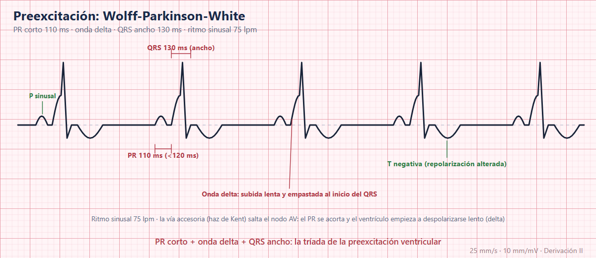 Síndrome de Wolff-Parkinson-White en el ECG
