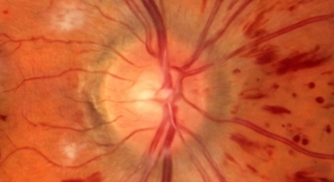 Fondo de ojo: Papila edematosa y hemorragias en llama (detalle)