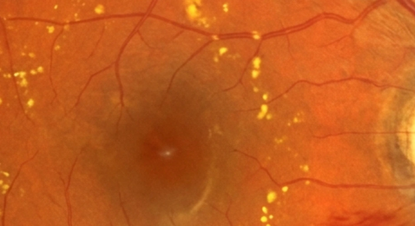 Fondo de ojo: Estrella macular incompleta (detalle)
