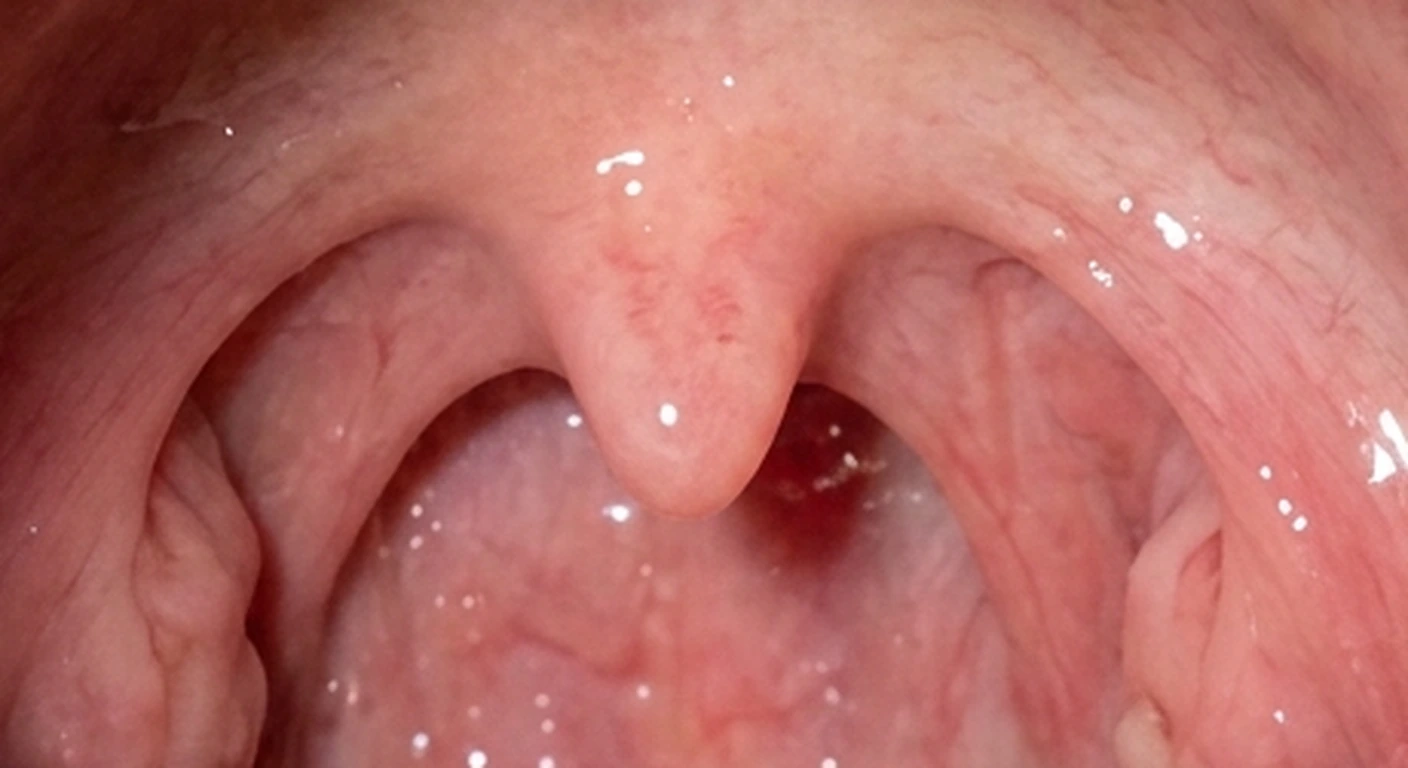 Otoscopia y orofaringoscopia: Amígdalas y úvula normales (detalle)