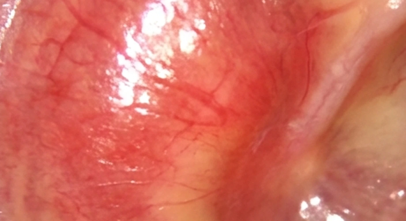 Otoscopia y orofaringoscopia: Abombamiento y vasos dilatados (detalle)