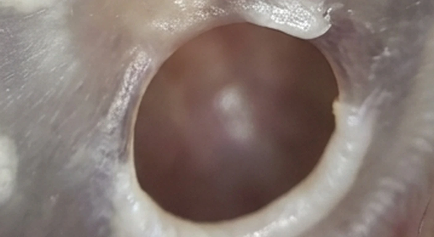 Otoscopia y orofaringoscopia: Agujero y promontorio al fondo (detalle)