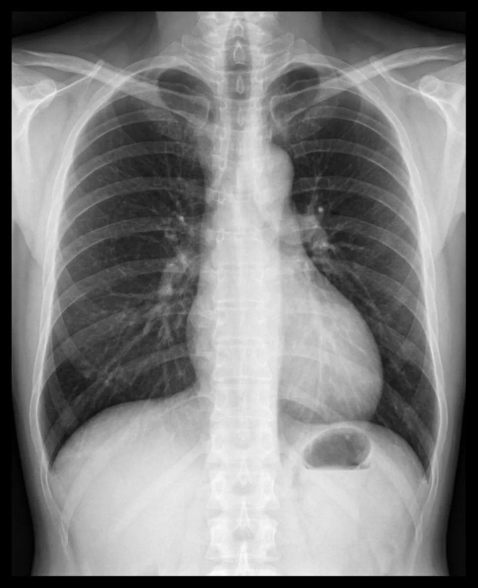 Cardiomegalia en radiografía de tórax