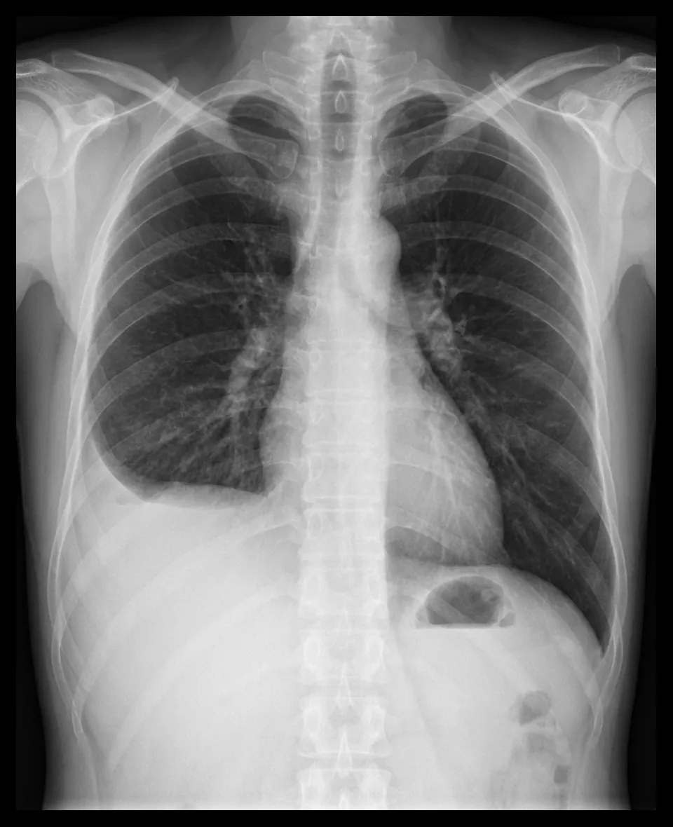Derrame pleural en radiografía de tórax
