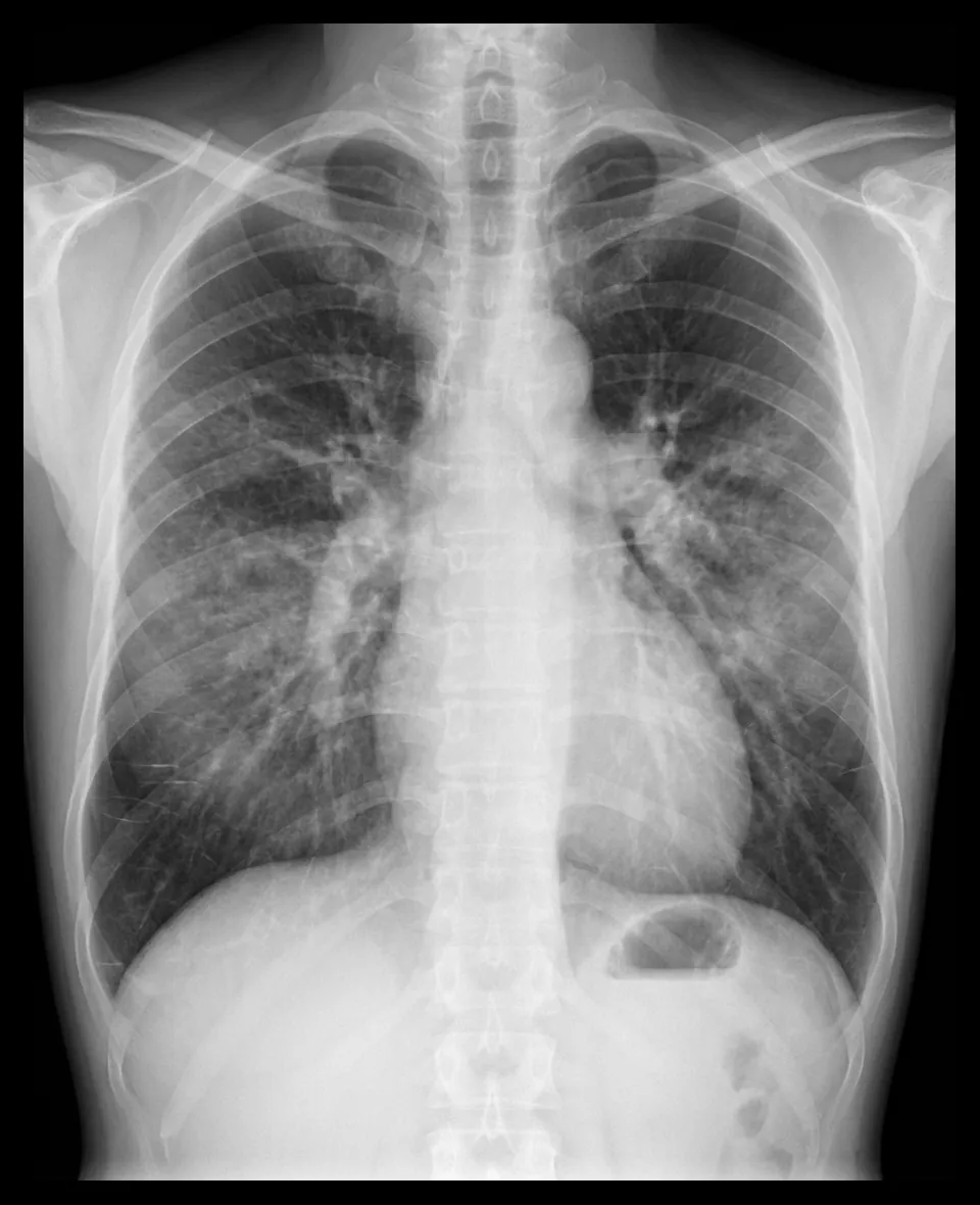 Edema pulmonar en radiografía de tórax