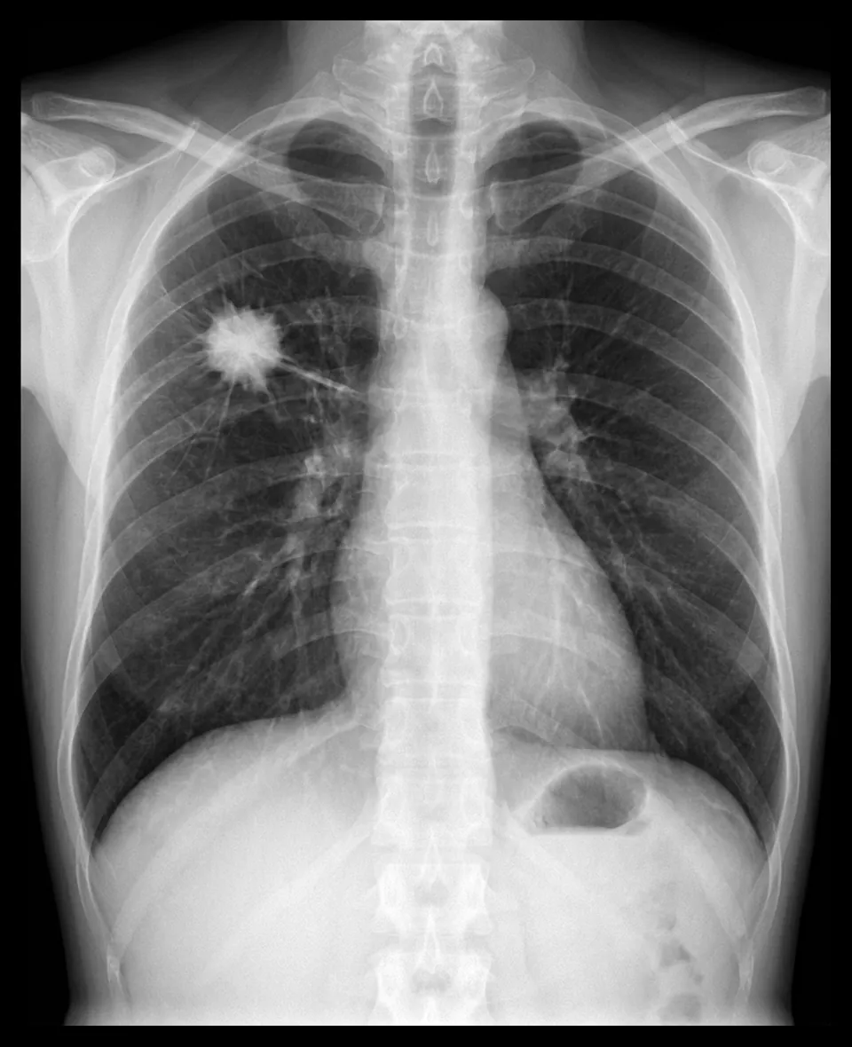 Masa pulmonar espiculada en el lóbulo superior derecho en radiografía de tórax