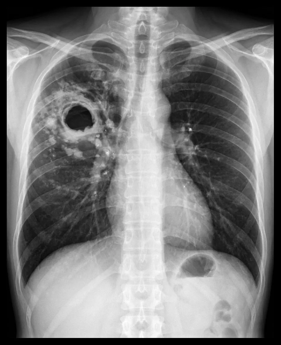 Tuberculosis pulmonar con cavitación apical en radiografía de tórax